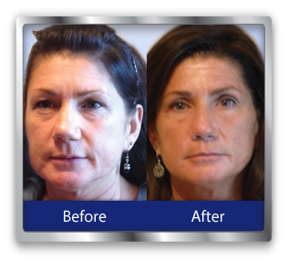 Neurotris PICO Toner Microcurrent Therapy System