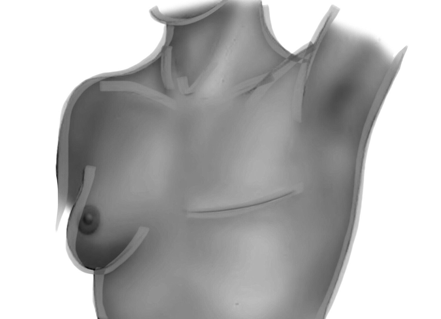 Breast Reconstruction Breast Reconstruction