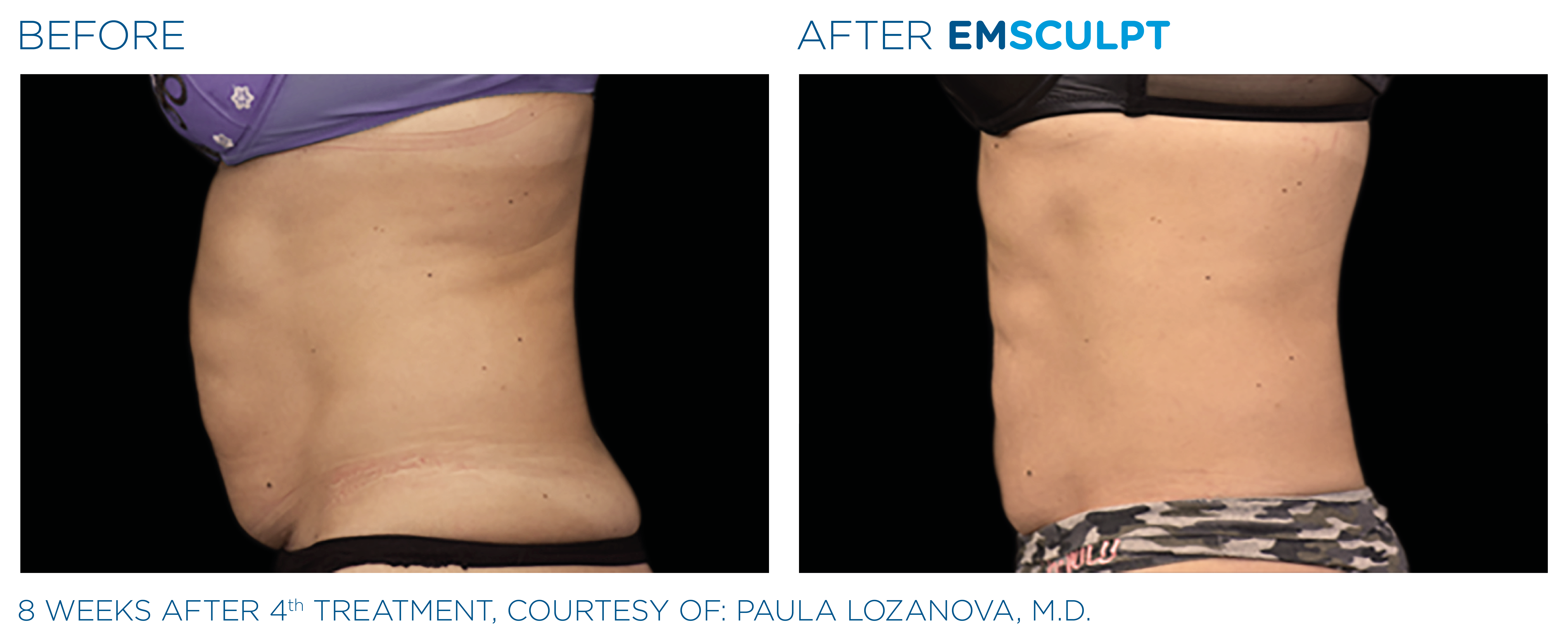 EmSculpt- 4 sessions