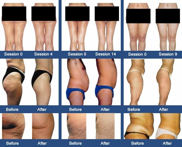 Endermologie Lipomassage - 4 sessions 00056