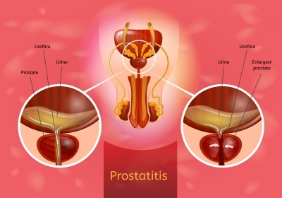 Prostatitis (taint pain) Get Rid of it in a week 00073