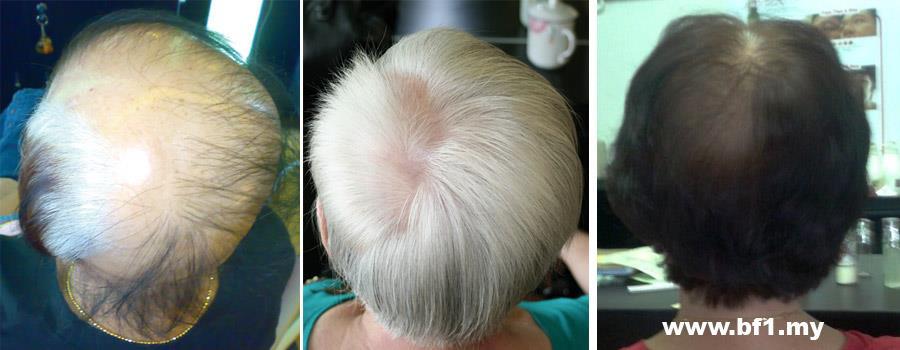 Control Hair Loss And Promoting Hair Growth within 7 days, money back guarantee. Hair Growth Home Care Set is for 30-45 days usage to testify our Hair Growth Result within 7 days. It helps to resolved more then 90% hair loss and scalp problems and perform new hair growth within 7 days of usage follow our direction. http://shop.bf-1.com/index.php?main_page=index&cPath=4