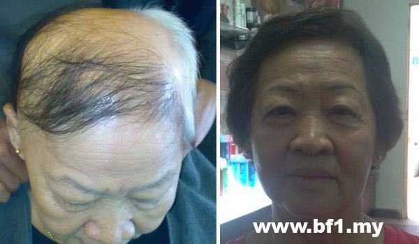 Control Hair Loss And Promoting Hair Growth within 7 days, money back guarantee. Hair Growth Home Care Set is for 30-45 days usage to testify our Hair Growth Result within 7 days. It helps to resolved more then 90% hair loss and scalp problems and perform new hair growth within 7 days of usage follow our direction. http://shop.bf-1.com/index.php?main_page=index&cPath=4