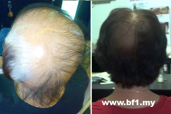 Control Hair Loss And Promoting Hair Growth within 7 days, money back guarantee. Hair Growth Home Care Set is for 30-45 days usage to testify our Hair Growth Result within 7 days. It helps to resolved more then 90% hair loss and scalp problems and perform new hair growth within 7 days of usage follow our direction. http://shop.bf-1.com/index.php?main_page=index&cPath=4