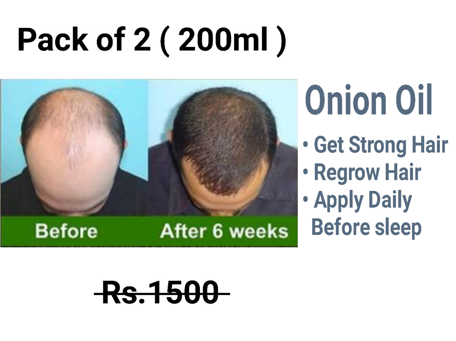 Onion Hair Oil Specially Made For Men Start Regrow Lost Hair In 14