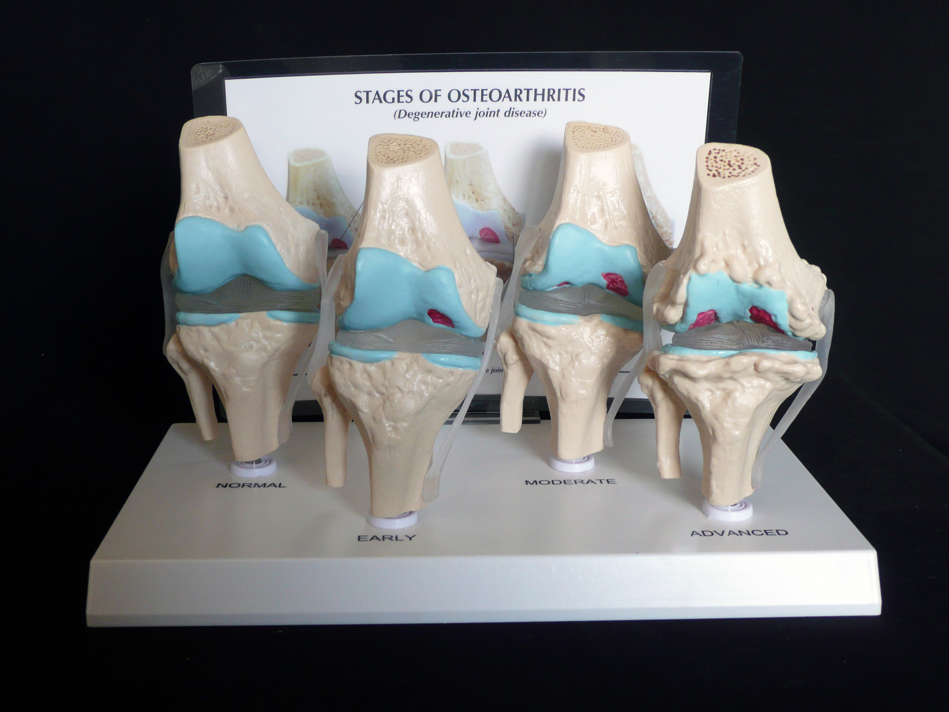 anatomical-human-degenerative-knee-joint-disease-model-joints