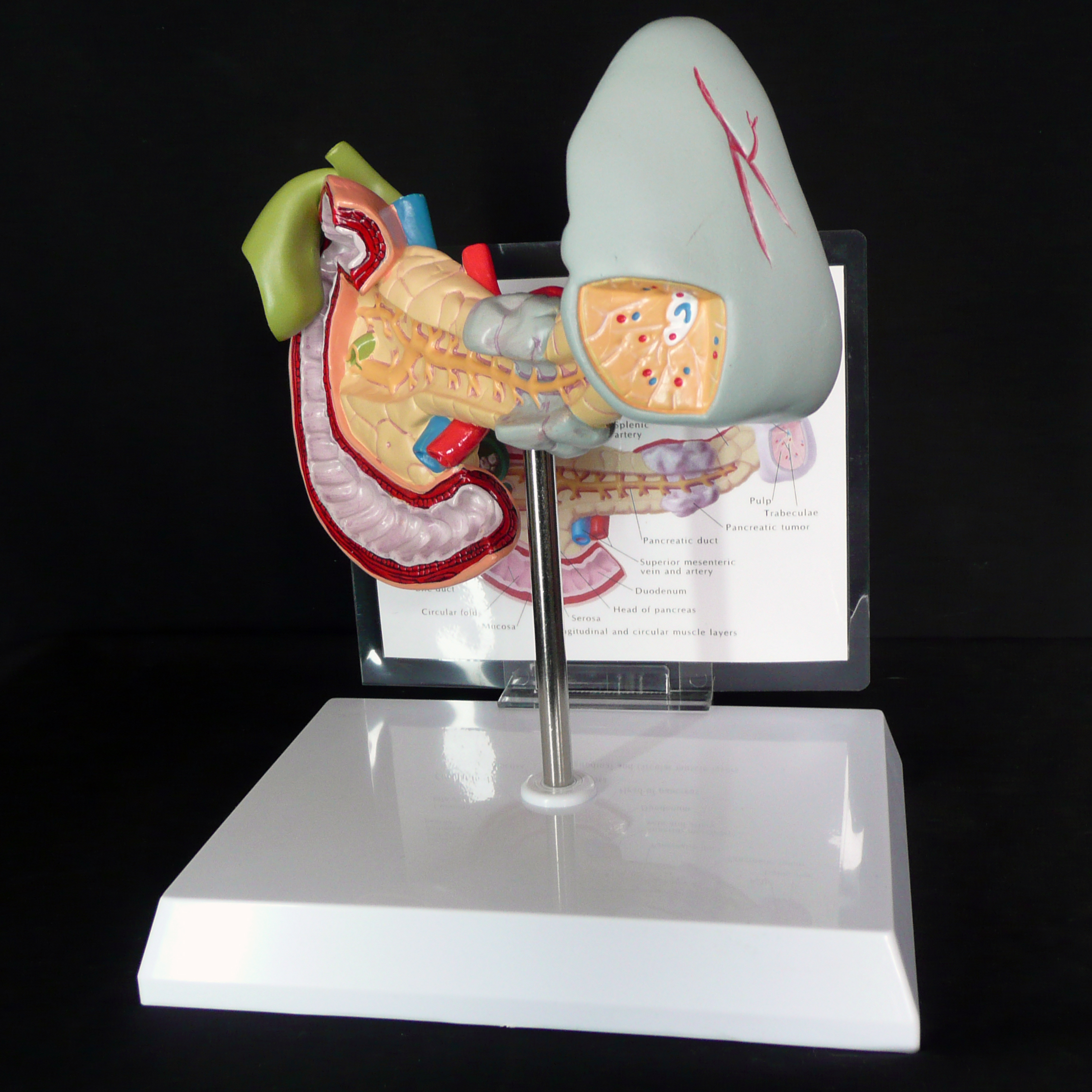 Anatomical Human Pancreas Spleen And Gallbladder Pathological Diseases