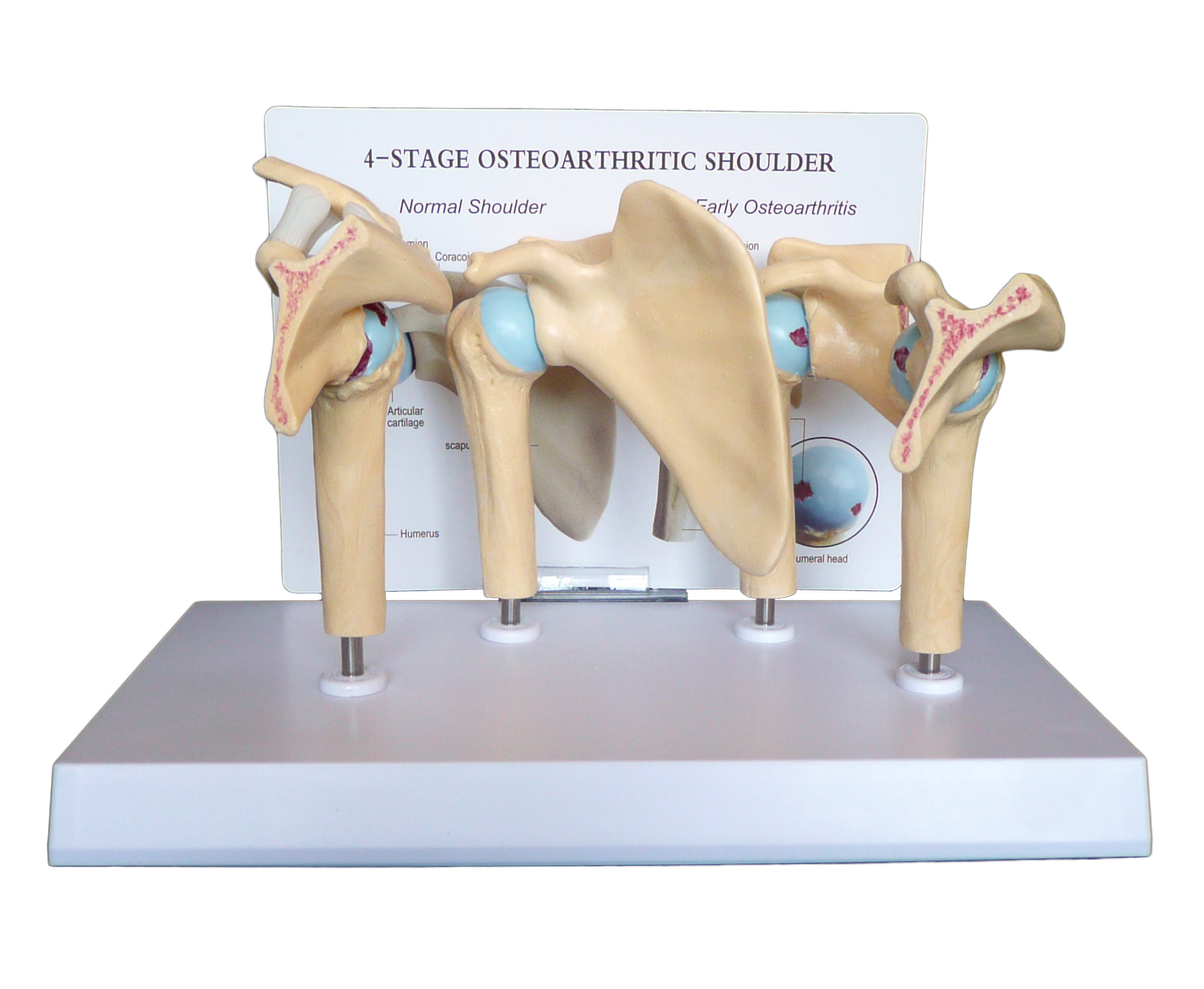 Anatomical Human Shoulder 4-Stage Osteoarthritic Glenohumeral Joint ...